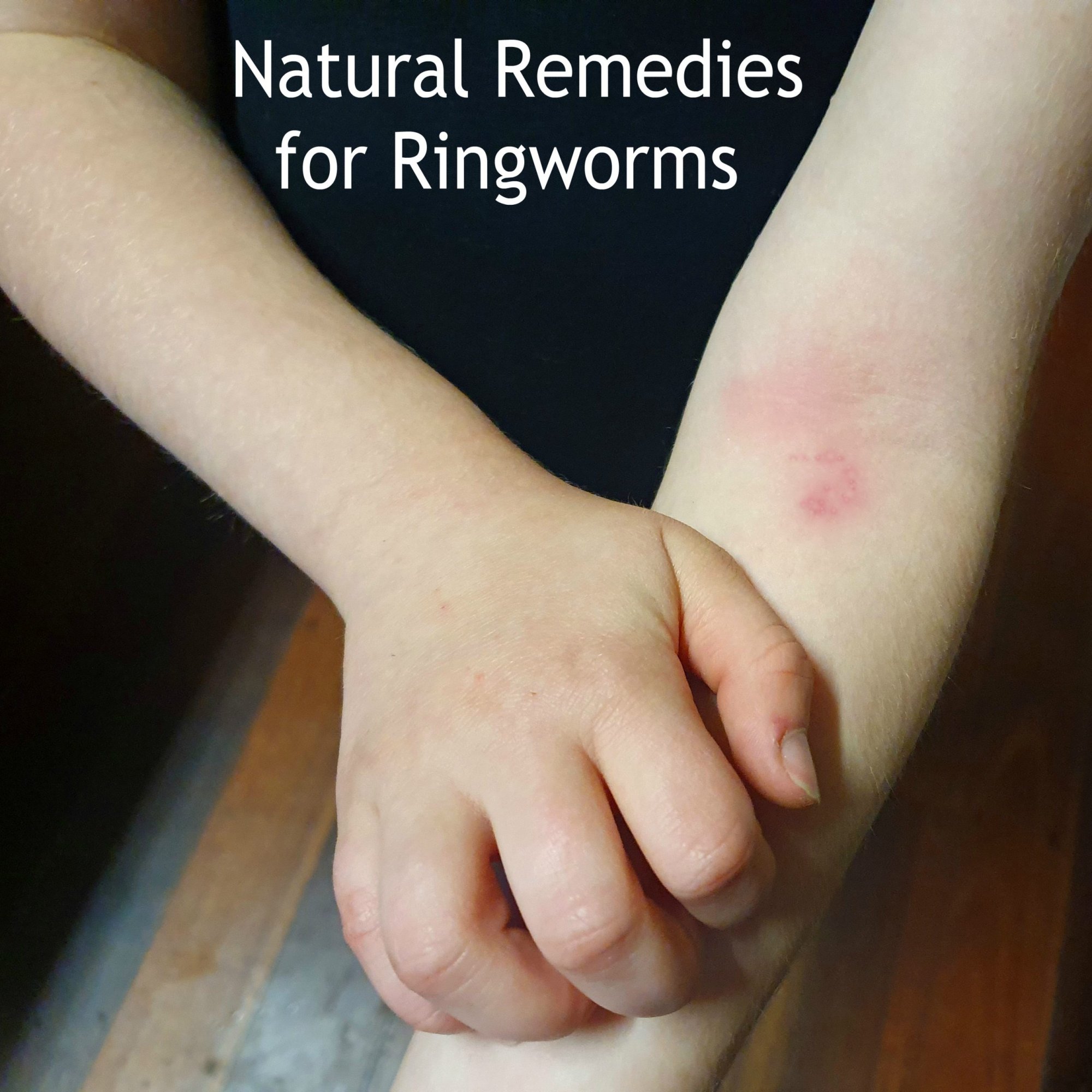 Cure Ringworm with Easy Home Remedies - HubPages