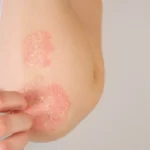 psoriasis skin disease